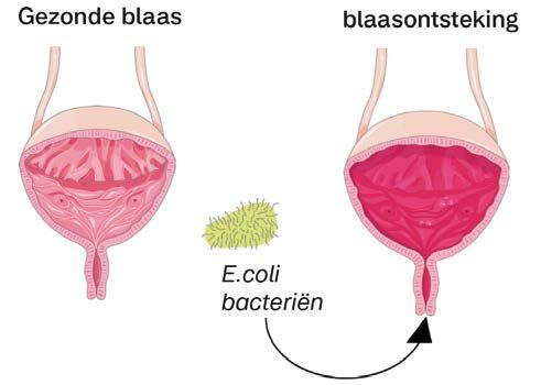 blaasontsteking